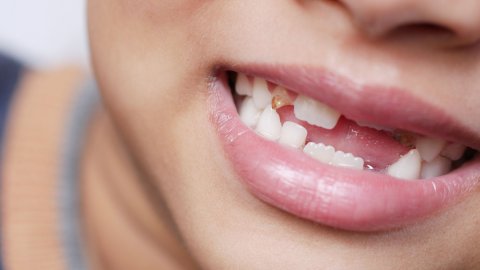 Rüyada Diş Kırılması Ve Rüyada Diş Dökülmesi